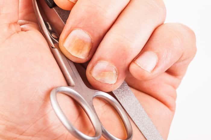 Nail fungus can cause discoloration.