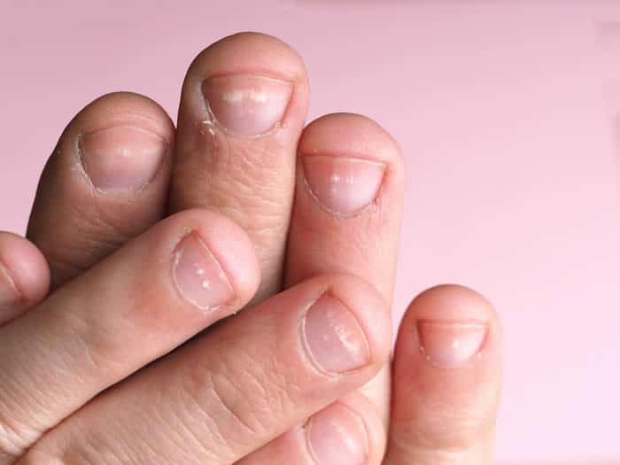White spots on nails can be a sign of trauma.