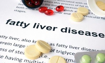 fatty liver disease aramchol