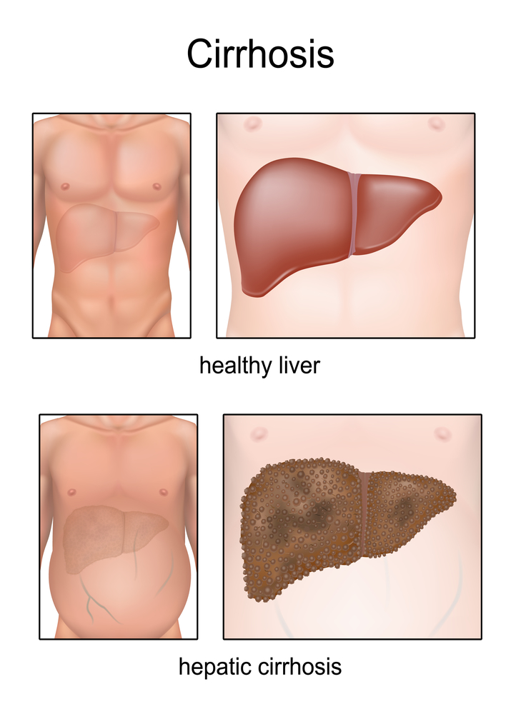 liver cirrhosis symptoms