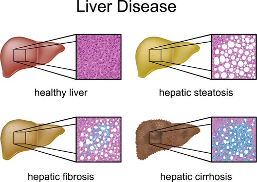 The stages of fatty liver disease.