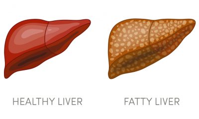 Game Changer in the Search for Fatty Liver Medication