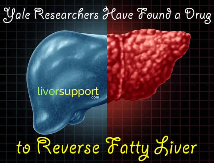 Yale Researchers Have Found a Drug to Reverse Fatty Liver