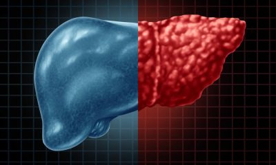 Yale Researchers Have Found a Drug to Reverse Fatty Liver