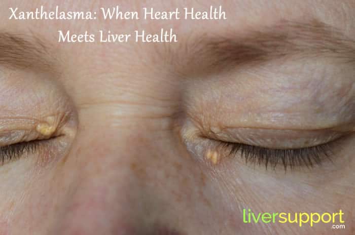 Xanthelasma: When Heart Health Meets Liver Health