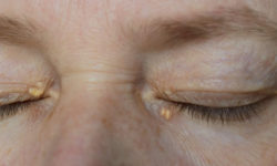 Xanthelasma: When Heart Health Meets Liver Health