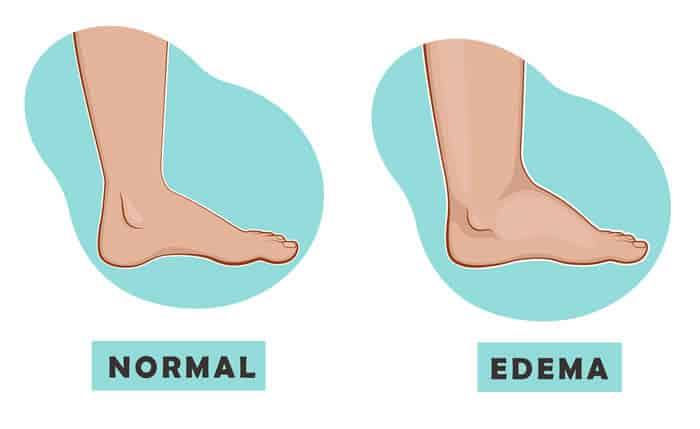 Pedal edema is a fatty liver disease symptom that can show up in your lower legs and feet.