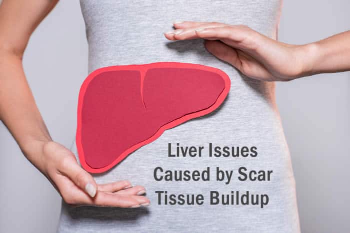 Liver Issues Caused by Scar Tissue Buildup
