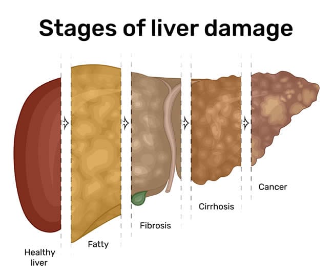 Scar tissue buildup can hurt your liver.