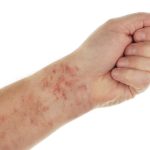 Fatty Liver Disease Skin Rash Symptoms & What to Look For