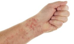 Fatty Liver Disease Skin Rash Symptoms & What to Look For