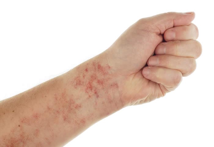 Fatty Liver Disease Skin Rash Symptoms & What to Look For