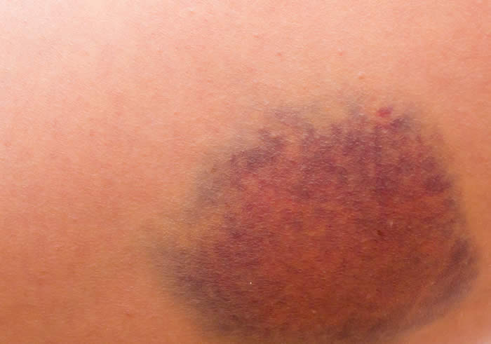People with liver disease may be more prone to bruising easily.