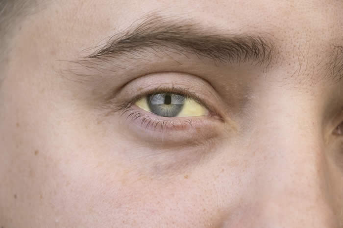 Yellow eyes, or jaundice, is a sign of liver disease.