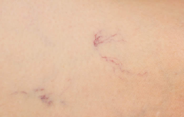 Spider veins can be a sign of liver disease.