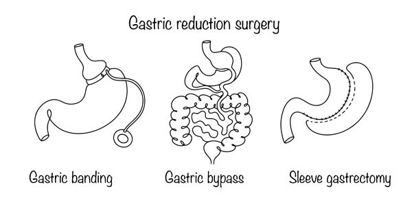 Types of bariatric surgery for weight loss.